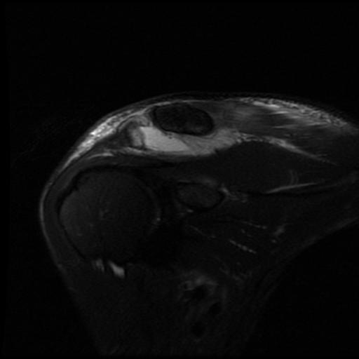 File:Acromioclavicular joint dislocation (Radiopaedia 14218-14076 Coronal PD fat sat 1).jpg