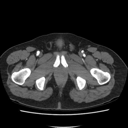 Active colonic bleed on CT (Radiopaedia 49765-55025 Axial C+ arterial phase 86).jpg