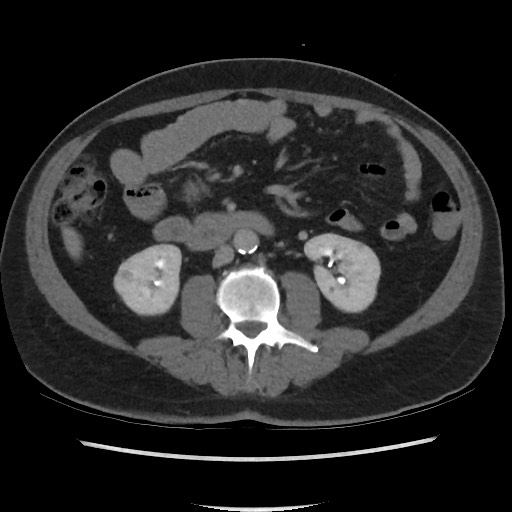 File:Active colonic bleed on CT (Radiopaedia 49765-55025 Axial C+ delayed 41).jpg