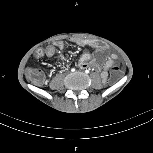 Active crohn disease (Radiopaedia 87133-103397 Axial C+ arterial phase 64).jpg