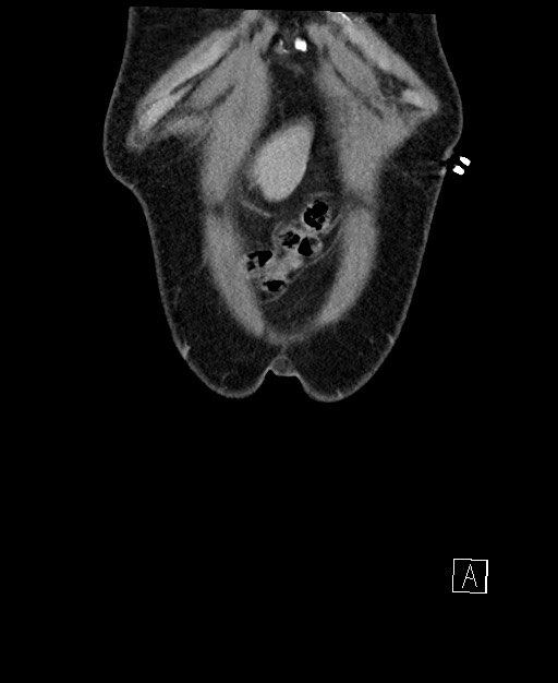 Active lower gastrointestinal bleeding - diverticular (Radiopaedia 61203-69106 Coronal C+ portal venous phase 9).jpg
