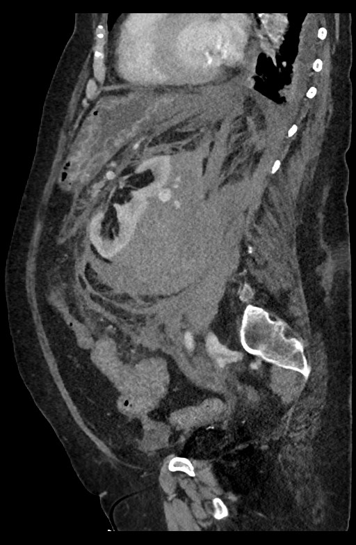 Active renal extravasation with large subcapsular and retroperitoneal hemorrhage (Radiopaedia 60975-68796 Sagittal C+ portal venous phase 95).jpg