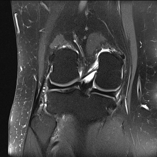 File:Acute-on-chronic transient lateral patellar dislocation with trochlear dysplasia (Radiopaedia 84099-99349 Coronal PD fat sat 15).jpg