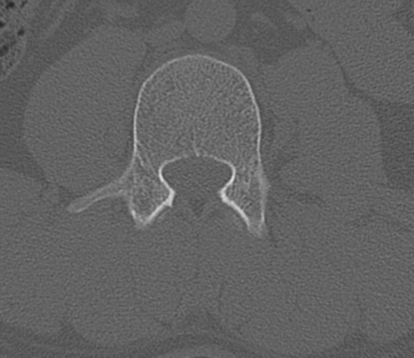 File:Acute L1 burst compression fracture (Radiopaedia 34430-35755 Axial bone window 46).png