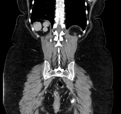 Acute appendicitis, heterotaxy syndrome (Radiopaedia 66884-76202 Coronal C+ portal venous phase 99).jpg