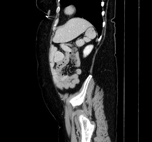 File:Acute appendicitis, heterotaxy syndrome (Radiopaedia 66884-76202 Sagittal C+ portal venous phase 104).jpg