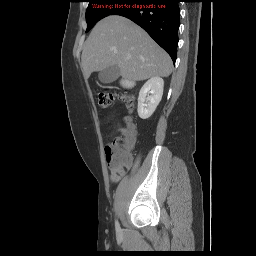 File:Acute appendicitis (Radiopaedia 10498-10973 Sagittal C+ portal venous phase 1).jpg