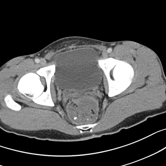 Acute appendicitis (Radiopaedia 32614-33572 Axial C+ portal venous phase 64).jpg