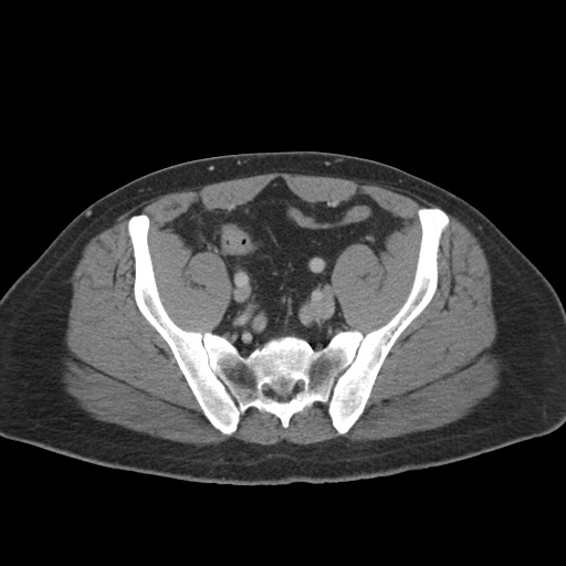 Acute appendicitis (Radiopaedia 48511-53463 Axial C+ portal venous phase 81).jpg