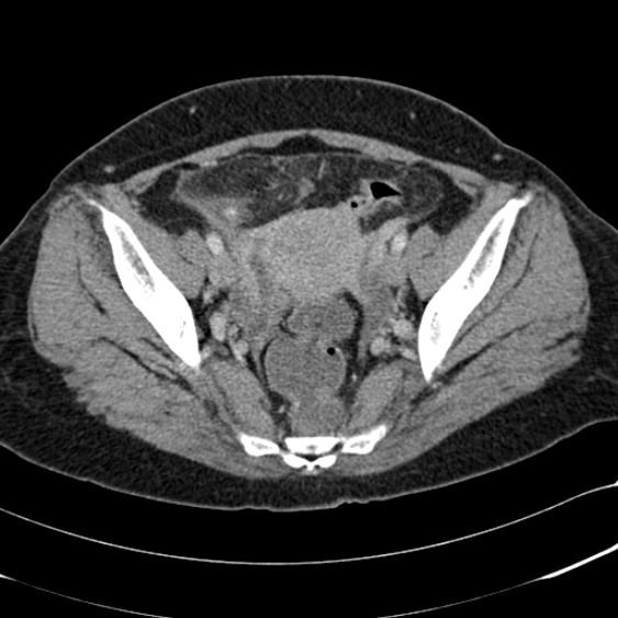 File:Acute appendicitis (Radiopaedia 48792-53822 Axial C+ portal venous phase 97).jpg