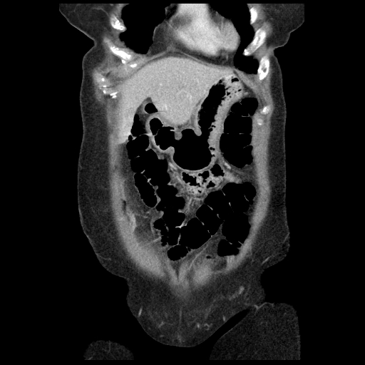 Acute appendicitis (Radiopaedia 52672-58589 Coronal C+ portal venous phase 3).jpg