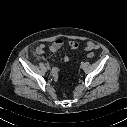 Acute appendicitis (Radiopaedia 58627-65818 Axial non-contrast 71).jpg