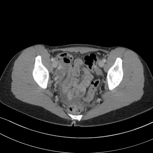 Acute appendicitis (Radiopaedia 62608-70901 Axial C+ portal venous phase 42).jpg