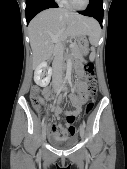 Acute appendicitis (Radiopaedia 62608-70901 Coronal C+ portal venous phase 18).jpg