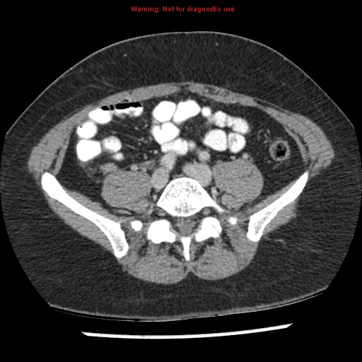 File:Acute appendicitis (Radiopaedia 7966-8812 C+ portal venous phase 34).jpg