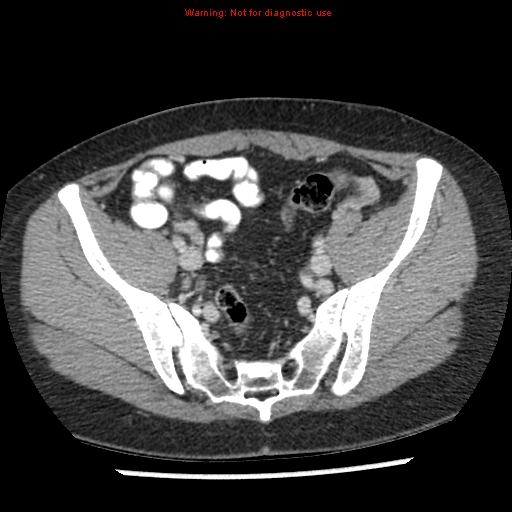 File:Acute appendicitis (Radiopaedia 7966-8812 C+ portal venous phase 42).jpg