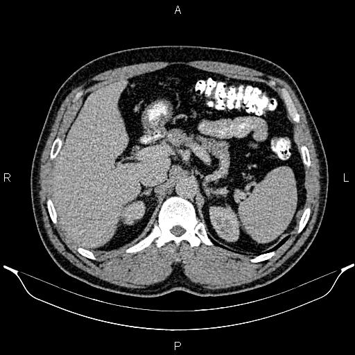 Acute appendicitis (Radiopaedia 84780-100240 Axial C+ portal venous phase 29).jpg
