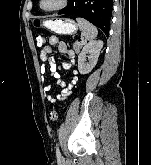 File:Acute appendicitis (Radiopaedia 84780-100240 Sagittal C+ portal venous phase 79).jpg