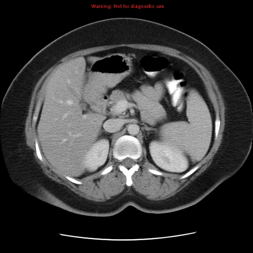 Acute appendicitis complicated by ovarian vein thrombophlebitis (Radiopaedia 16172-15851 Axial C+ portal venous phase 34).jpg