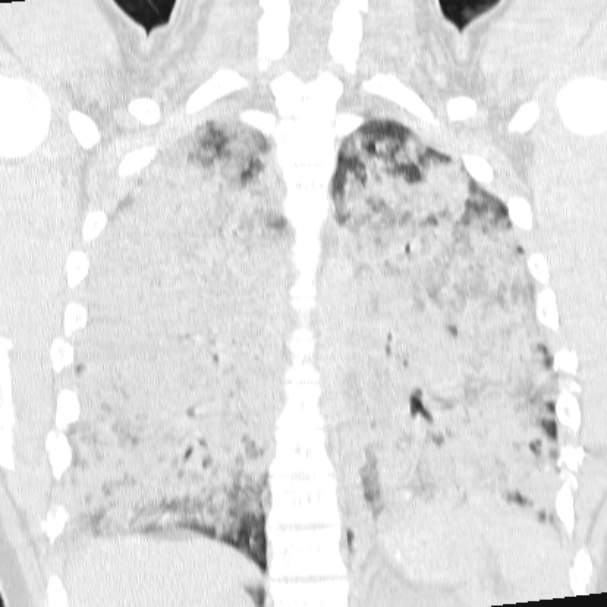 Acute aspiration pneumonitis (Radiopaedia 33605-34703 Coronal lung window 55).jpg