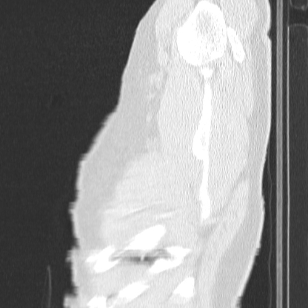 Acute aspiration pneumonitis (Radiopaedia 33605-34703 Sagittal lung window 7).jpg