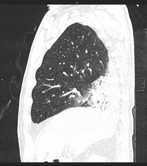 Acute aspiration pneumonitis (Radiopaedia 55642-62166 Sagittal lung window 110).jpg