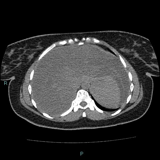 Acute bilateral pyelonephritis (Radiopaedia 37146-38881 Axial non-contrast 15).jpg