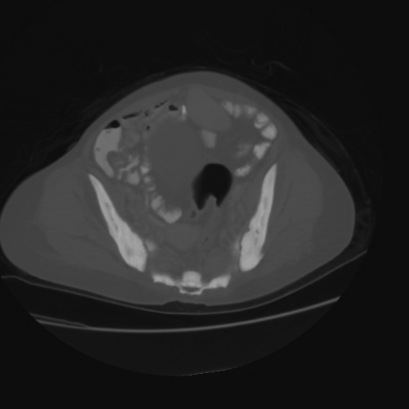 Acute calculous cholecystitis in patient with osteopetrosis (Radiopaedia 77871-90159 Axial bone window 41).jpg