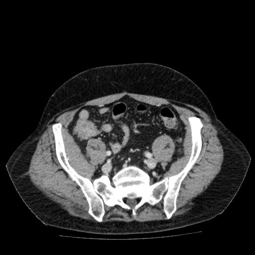 Acute cholecystitis and incidental left sided IVC (Radiopaedia 49352-54459 Axial C+ portal venous phase 116).jpg