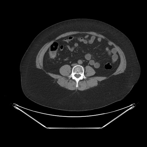 File:Acute cholecystitis with tensile fundus sign (Radiopaedia 71394-81723 Axial non-contrast 64).jpg