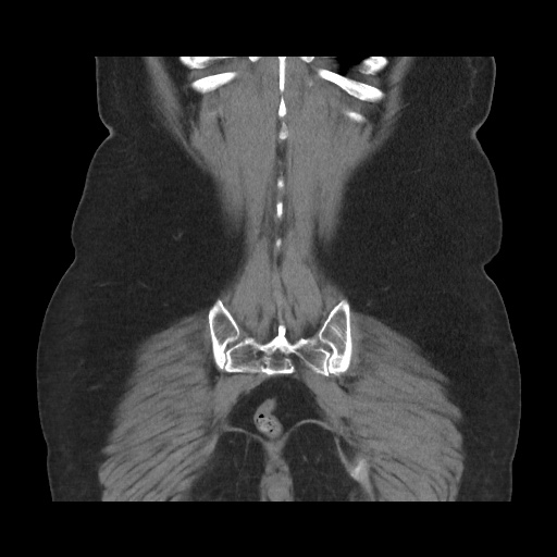 Acute cholecystitis with tensile fundus sign (Radiopaedia 71394-81723 Coronal non-contrast 102).jpg