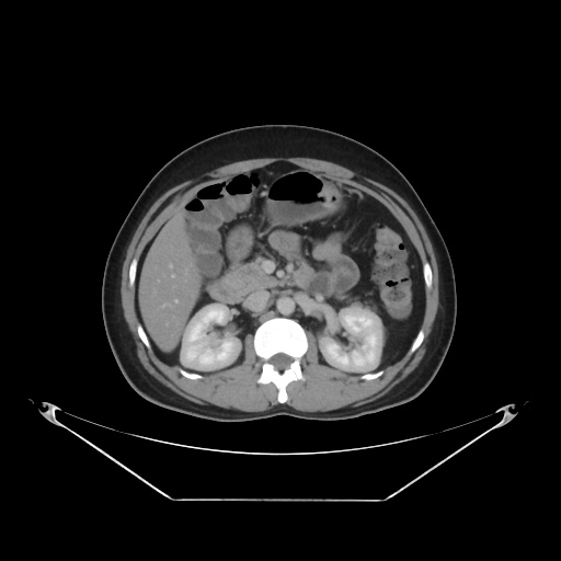 File:Acute complicated calculous cholecystitis (Radiopaedia 55202-61587 Axial C+ delayed 41).jpg