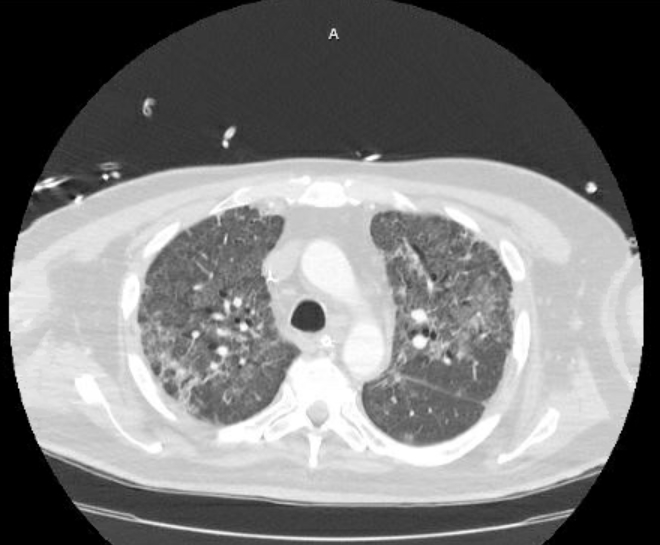 Acute cor pulmonale (ultrasound) (Radiopaedia 83508-98818 Axial lung window 29).jpg