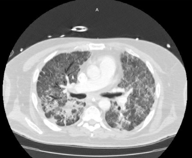 Acute cor pulmonale (ultrasound) (Radiopaedia 83508-98818 Axial lung window 42).jpg