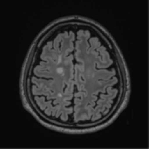 Acute disseminated encephalomyelitis (ADEM)- Anti-NMDA receptor encephalitis (Radiopaedia 54920-61201 Axial FLAIR 51).png