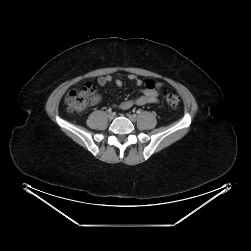 Acute diverticulitis - transverse colon (Radiopaedia 87063-103327 Axial C+ portal venous phase 109).jpg