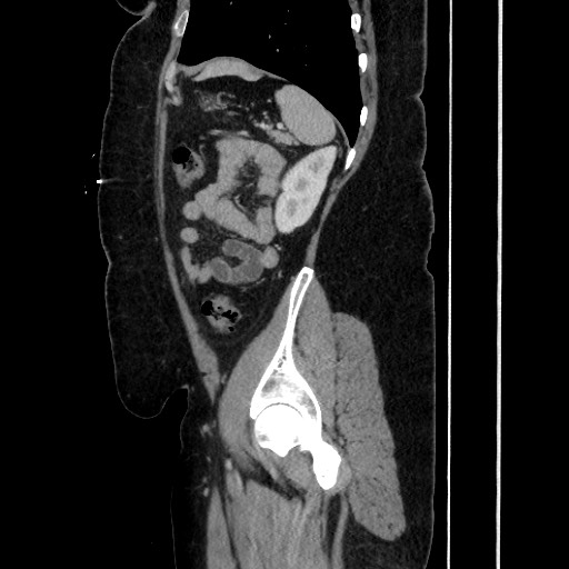 Acute diverticulitis - transverse colon (Radiopaedia 87063-103327 Sagittal C+ portal venous phase 167).jpg