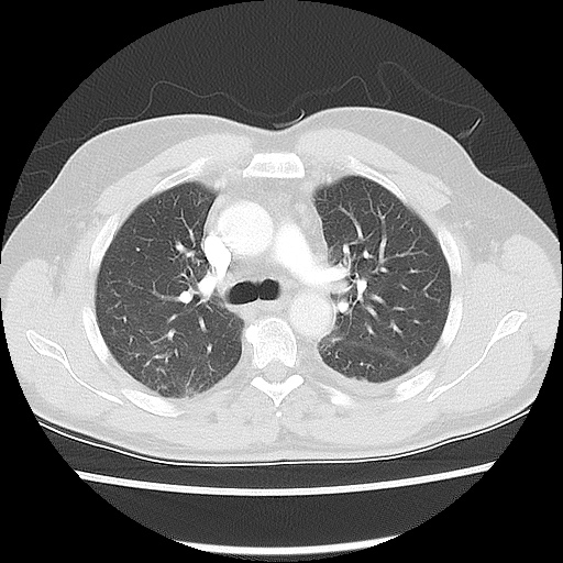 Acute epicardial fat necrosis (Radiopaedia 42327-45440 Axial lung window 24).jpg