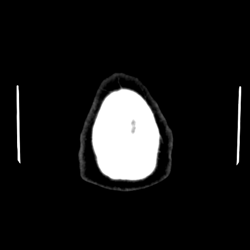 Acute hemorrhagic stroke (Radiopaedia 17507-17223 Axial non-contrast 50).jpg