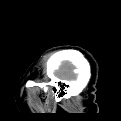File:Acute hemorrhagic stroke (Radiopaedia 17507-17223 Sagittal non-contrast 3).jpg