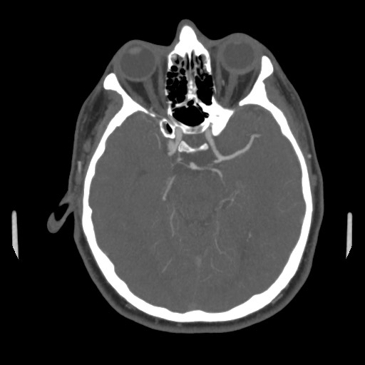 File:Acute internal carotid artery dissection (Radiopaedia 53541-59630 D 32).jpg
