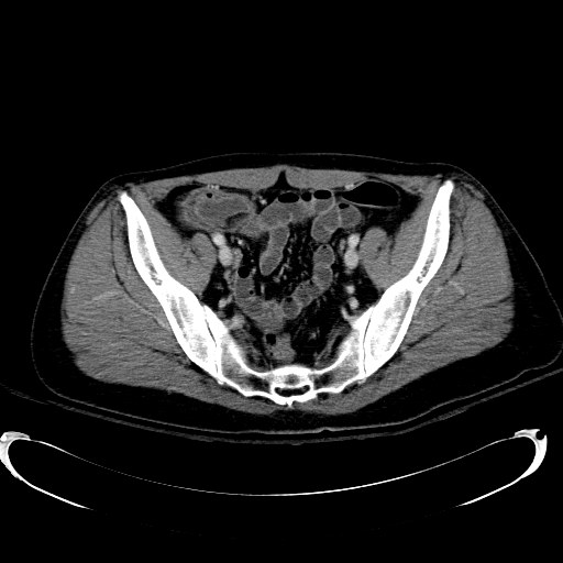 File:Acute myocardial infarction in CT (Radiopaedia 39947-42415 Axial C+ portal venous phase 106).jpg