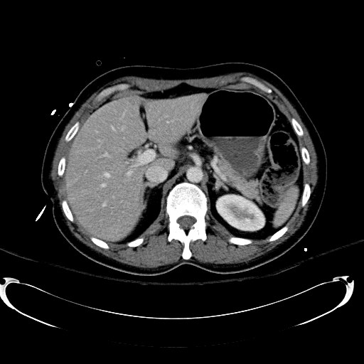 File:Acute myocardial infarction in CT (Radiopaedia 39947-42415 Axial C+ portal venous phase 36).jpg