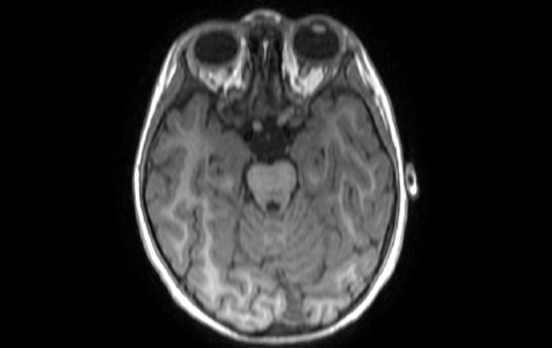 File:Acute necrotizing encephalitis of childhood (Radiopaedia 67356-76737 Axial T1 64).jpg