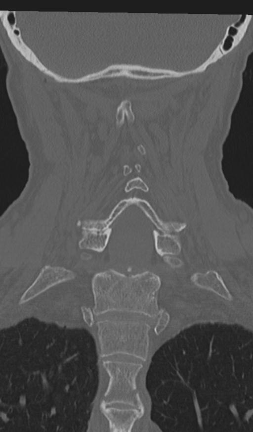 Acute on chronic subdural hematoma and thoracic vertebral injury in a multitrauma patient (Radiopaedia 31698-32619 Coronal bone window 41).jpg