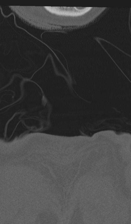 Acute on chronic subdural hematoma and thoracic vertebral injury in a multitrauma patient (Radiopaedia 31698-32619 Coronal bone window 84).jpg