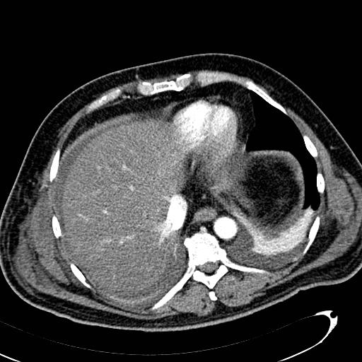 File:Acute pancreatic necrosis (Radiopaedia 13560-13486 Axial C+ portal venous phase 23).jpg
