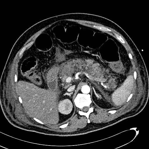 File:Acute pancreatic necrosis (Radiopaedia 13560-13486 Axial C+ portal venous phase 51).jpg