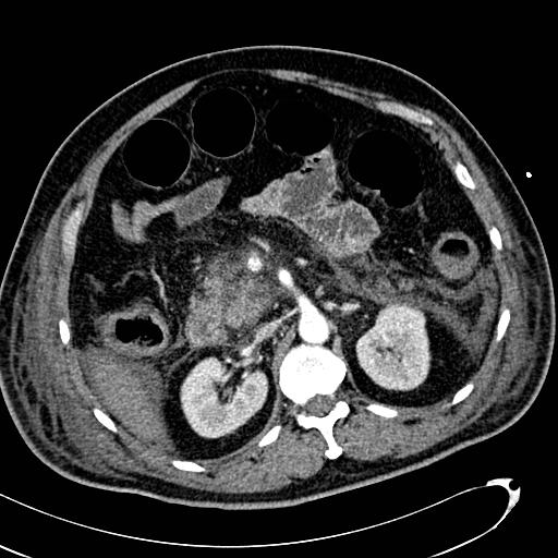 File:Acute pancreatic necrosis (Radiopaedia 13560-13486 Axial C+ portal venous phase 61).jpg