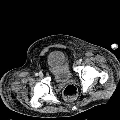 Acute pancreatic necrosis (Radiopaedia 13560-18501 Axial C+ portal venous phase 141).jpg